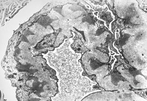 F,74y. | membranous glomerulopathy F,74y. | membranous glomerulopathy